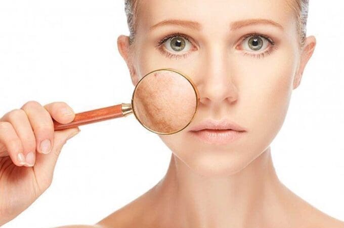 Best Makeup To Cover Melasma