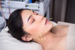 acupuncture for melasma