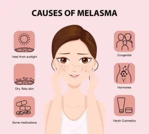 heat melasma