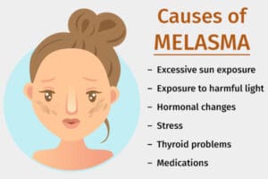 what causes melasma