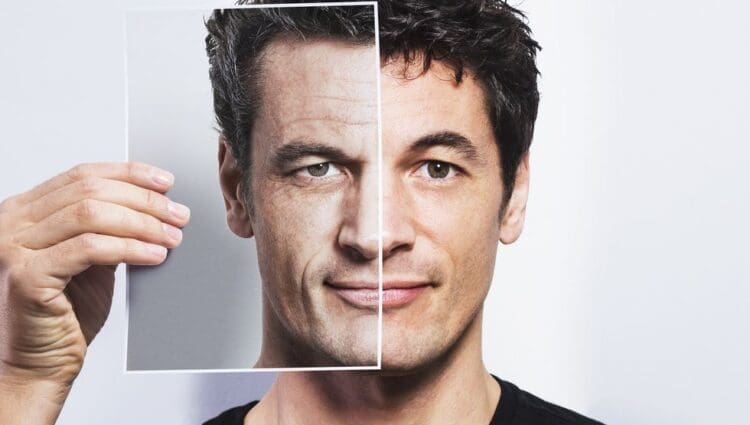 Melasma In Men