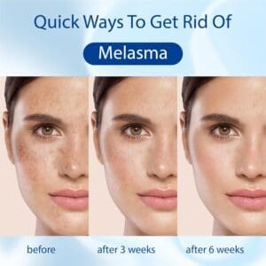 retinol melasma