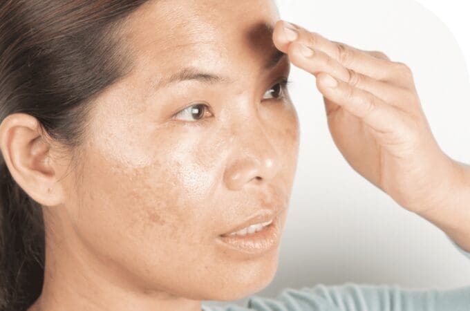 What Is Melasma And Chloasma