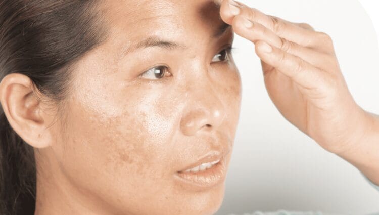 What Is Melasma And Chloasma