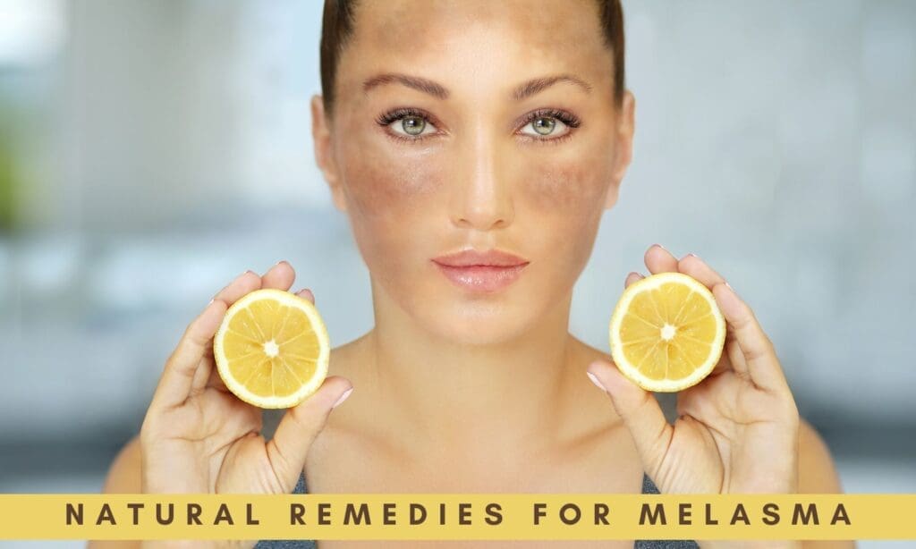 natural remedies for melasma