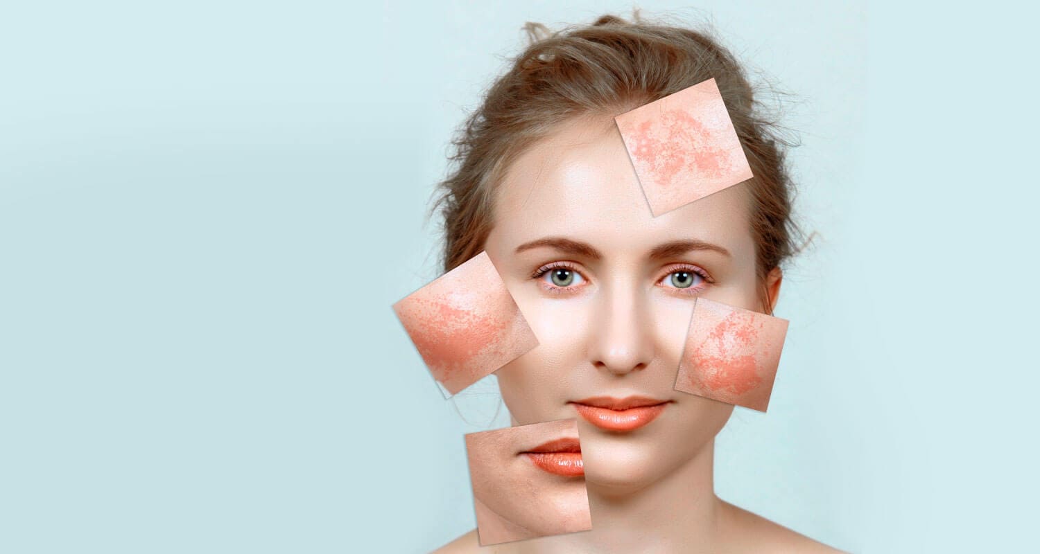 what is melasma and chloasma