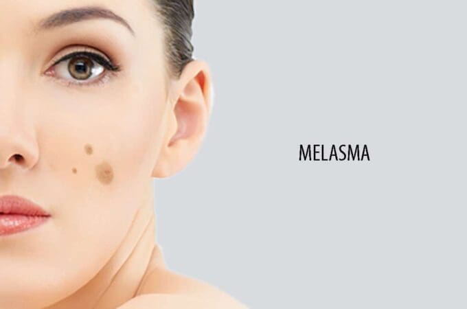 What Causes Melasma