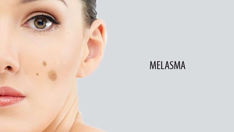 What Causes Melasma