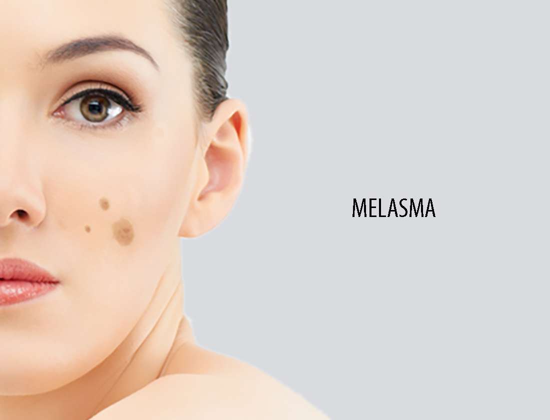 what causes melasma